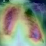 Chest X-ray detection samples