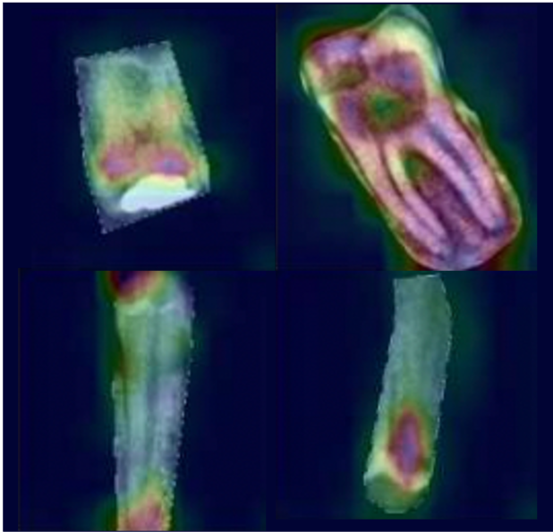 Tooth Extraction and Caries Detection